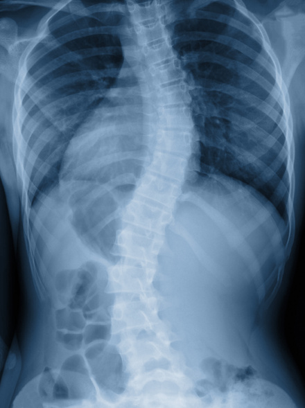 Scoliosis film -ray show spinal bend in teenager patient